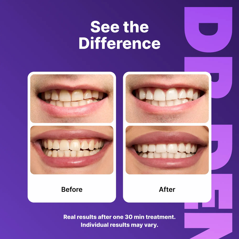DRDENT Purple Teeth Whitening Strips - 7/21 Whitening Sessions - Non Sensitive Teeth Whitening - Peroxide-Free — image 5